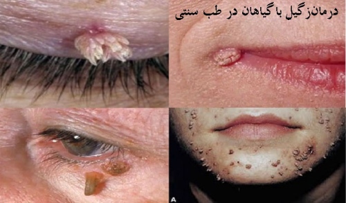 درمان زگیل با گیاهان در طب سنتی