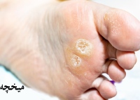میخچه دست و پا